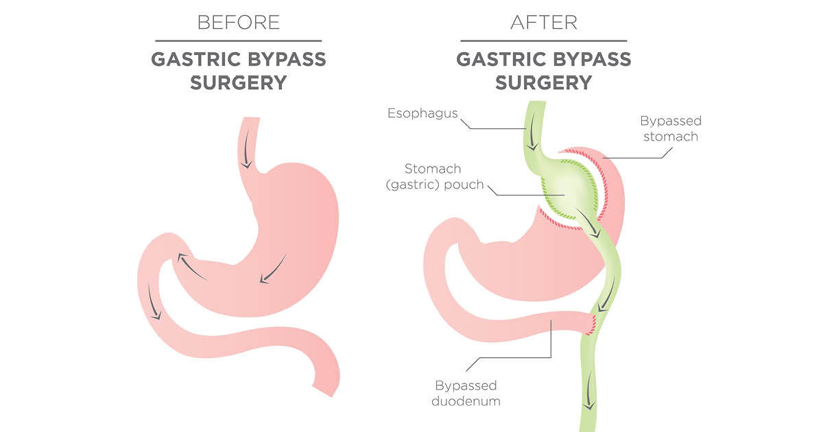 gastric bypass surgery