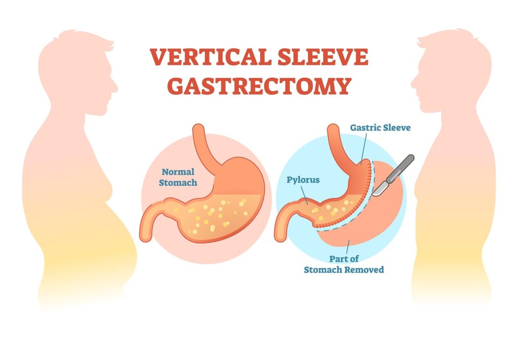 Lose Weight Fast With Gastric Sleeve Surgery